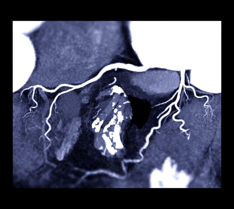 CT coronary angiogram of heart arteries